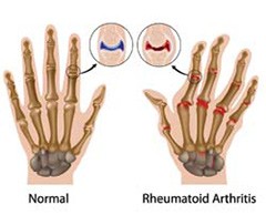 rheumatoid arthritis