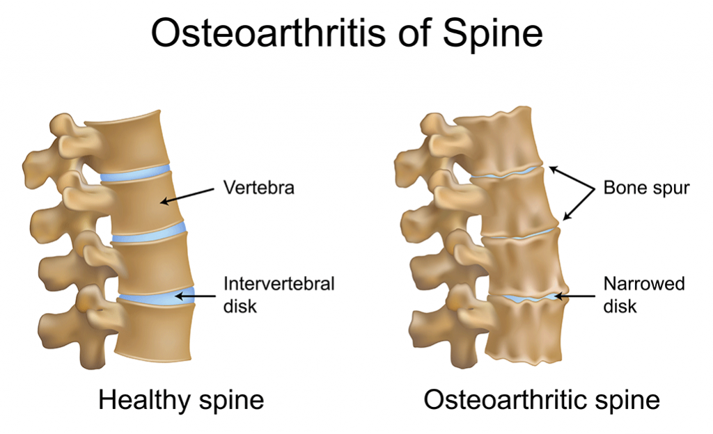 osteoarthritis